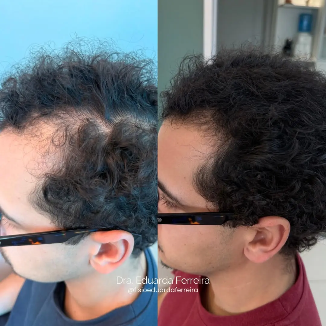 Resultado do tratamento capilar - Antes e Depois 1