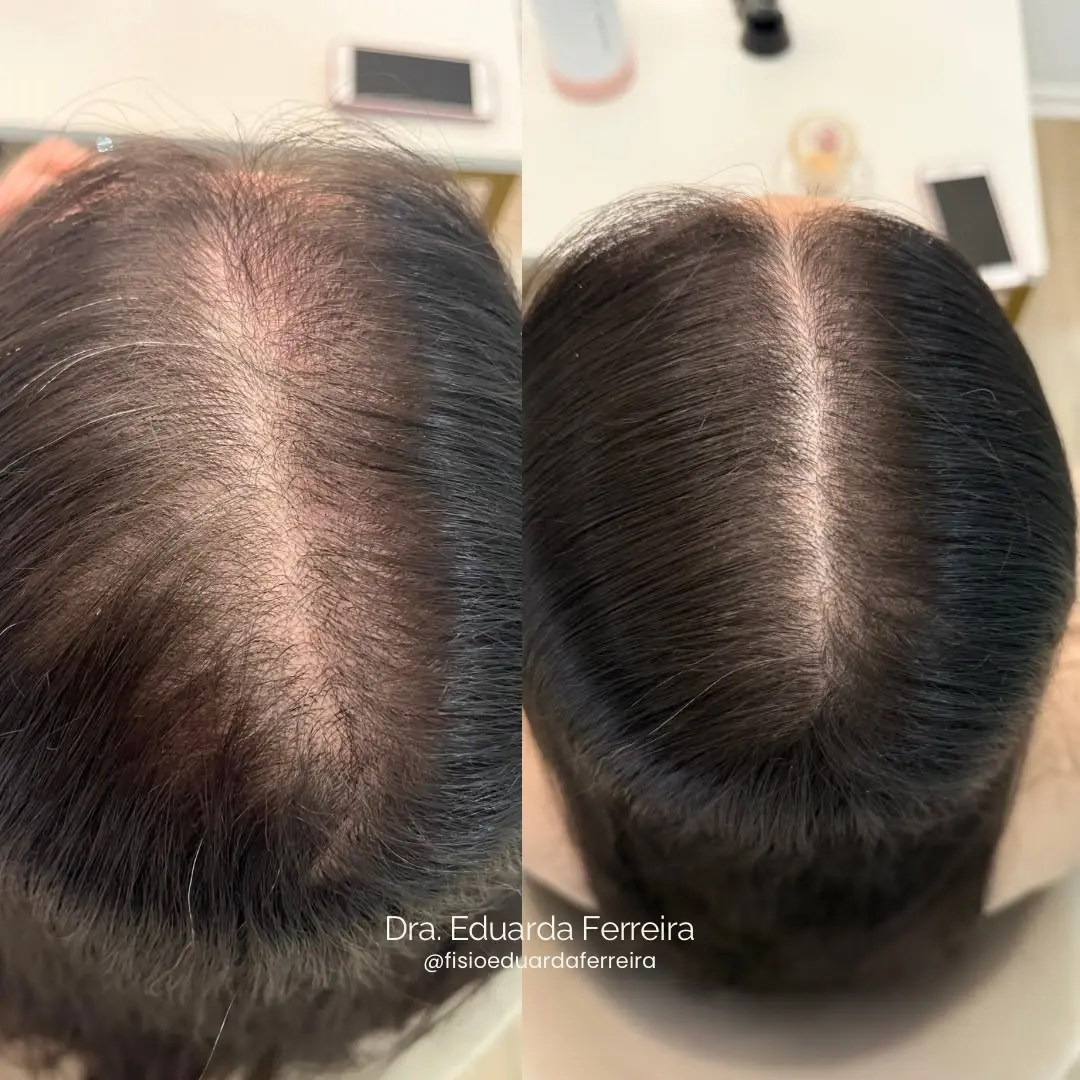 Resultado do tratamento capilar - Antes e Depois 4