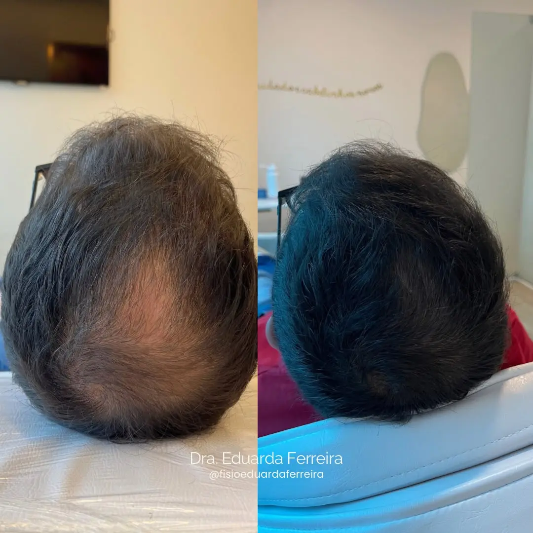 Resultado do tratamento capilar - Antes e Depois 6